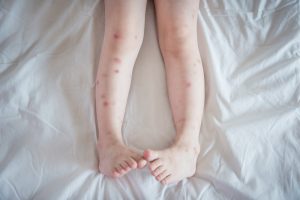 Do Bed Bugs Only Target Legs?